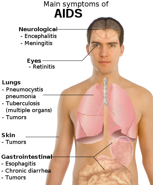 This diagram lists the main symptoms of aids for various parts of the human body. Some of the symptoms include meningitis, tuberculosis, retinitis and tumors.