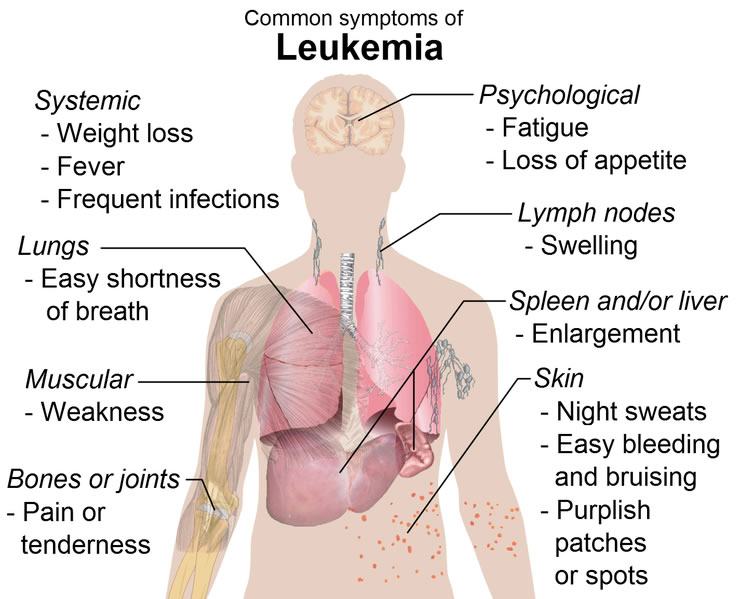 This diagram shows the common symptoms of chronic and acute leukemia. They include a number of different symptoms which include conditions affecting the lungs, muscles, spleen, skin, bones and joints.