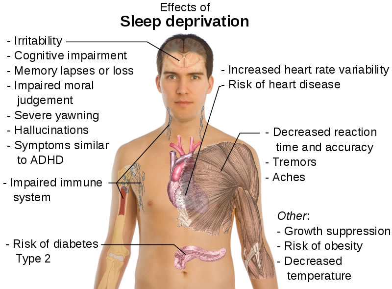This diagram shows the main health effects of sleep deprivation listed next to a human body. Some of the effects include irritability, memory lapses, tremors, decreased reaction time and an impaired immune system.