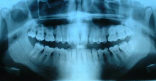 This is an x-ray photo of human teeth. The photo shows that the roots of teeth run deep into the mouth.