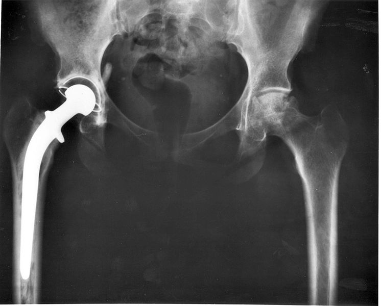 An xray photo of a patient’s right hip joint that has been replaced by a metal head and a plastic cup.