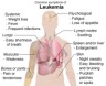 leukemia symptoms